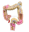 Digestive Model-Pathological Model of Human Large Intestine-Ningbo (CM):002x00x00