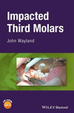 Third Molar Extraction