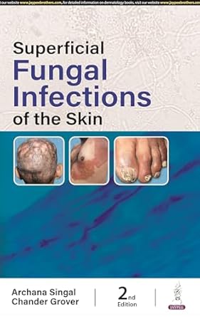 Superficial Fungal Infections of the Skin, 2e
