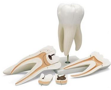 Dentistry Model-Giant Molar with Dental Cavities Human Tooth Model, 15 Times Life-Size, 6 Part-3B(CM):24x13x12