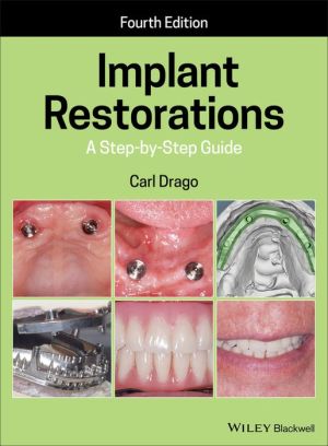 Implant Restorations: A Step-by-Step Guide, 4e