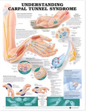 Understanding Carpal Tunnel Syndrome Chart